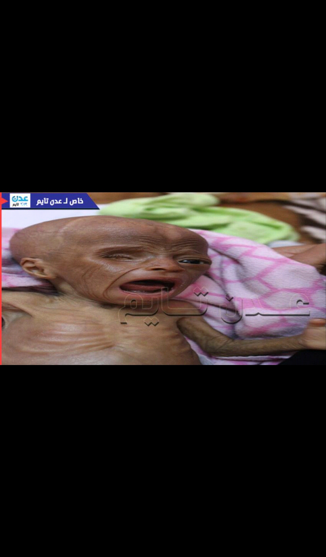 شاهد...صحيفة عدنية تلتقط صور مرعبة و (صادمة) لأطفال يعانون من سوء تغذية في العاصمة عدن واستياء دولي عارم 